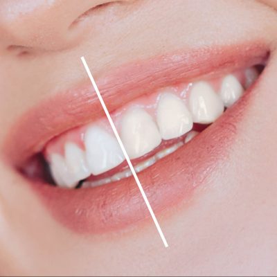 Closeup of smile with white teeth. Healthy female teeth.Toothy smile
